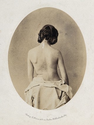 A woman, viewed from behind, naked to the waist; revealing mobility of left shoulder. Photograph by L. Haase after H.W. Berend, 1859.