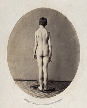 view A naked young man, viewed from behind in full-length, revealing a deformity in left arm and shoulder. Photograph by L. Haase after H.W. Berend, 1860.