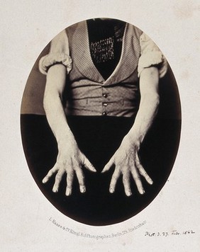 A man's hands, palms down, opened out and spread onto black cloth, showing misshapen fingers. Photograph by L. Haase after H.W. Berend, 1862.