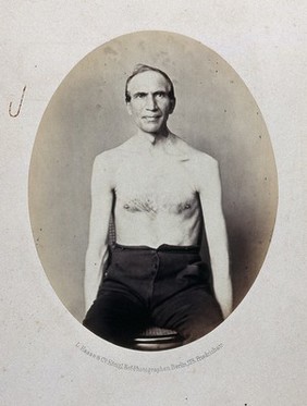 A seated man, bare-chested and viewed from the front. Photograph by L. Haase after H.W. Berend, 1862.