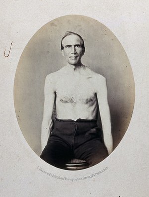 view A seated man, bare-chested and viewed from the front. Photograph by L. Haase after H.W. Berend, 1862.