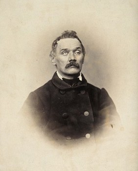 A man, head and shoulders; his left eyelid is heavy and his right eye is raised. Photograph by L. Haase after H.W. Berend, 1863.