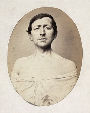 view A man, head and shoulders; his shirt undone. Photograph by L. Haase after H.W. Berend, 1863.