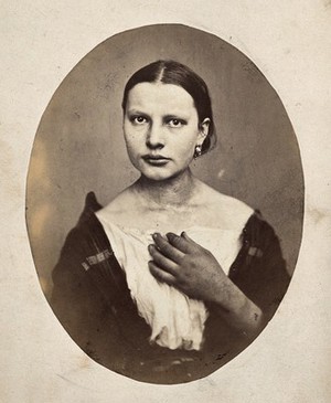 view A woman, head and shoulders; she has a bump on her right shoulder. Photograph by L. Haase after H.W. Berend, 1864.