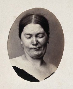 A woman's head and neck; her eyes are closed and her mouth twisted into a grimace. Photograph by L. Haase after H.W. Berend, 1864.