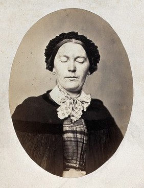 A woman's head and shoulders; her eyes are closed and her mouth shows a slight grimace. Photograph by L. Haase after H.W. Berend, 1864.