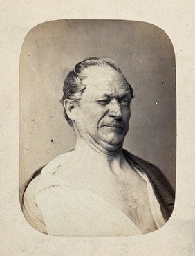 A man's head and shoulders, the right side of his face is contorted. Photograph by L. Haase after H.W. Berend, 1864.