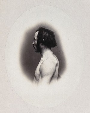 view A man's head and left shoulder, unclothed and viewed from the side. Photograph by L. Haase after H.W. Berend, 1865.