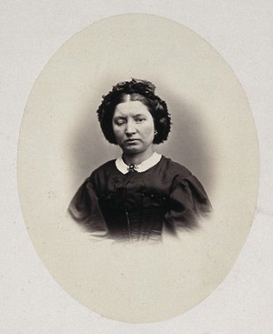 view A woman's head and shoulders, her right eyelid is heavier than her left. Photograph by L. Haase after H.W. Berend, 1865.