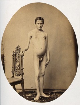 A naked young man, viewed from the front in full length; the top of his rib cage appears to be sunken. Photograph by L. Haase after H.W. Berend, c. 1865.