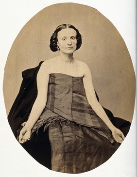 A woman seated; she is partially clothed with her arms extended and the left side of her face appears slightly deformed. Photograph by L. Haase for H.W. Berend, c. 1865.