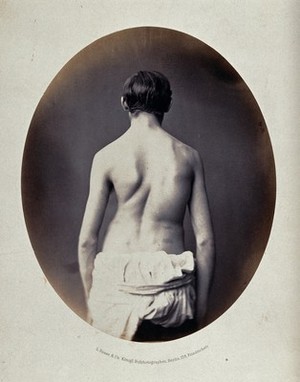 view A partially clothed man, standing, viewed from behind; his spine appears severely deformed. Photograph by L. Haase for H.W. Berend, c. 1865.