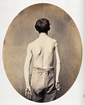 view A partially clothed man, standing, viewed from the back; his right arm and shoulder appear severely deformed. Photograph by L. Haase for H.W. Berend, c. 1865.