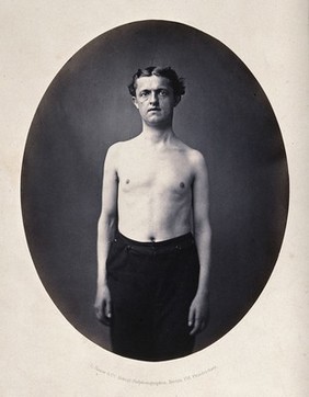 A partially clothed man, standing, viewed from the front; his left shoulder appears slightly small. Photograph by L. Haase after H.W. Berend, c. 1865.