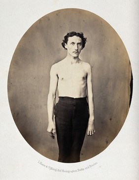 A standing man, 3/4 length view, partially clothed; his left arm appears deformed. Photograph by L. Haase after H.W. Berend, c. 1865.