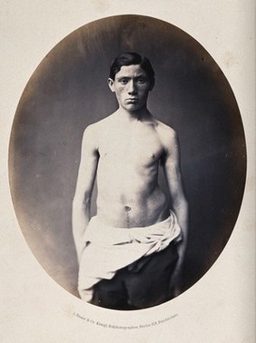A standing young man, 3/4 length view, partially clothed; showing a deformity of the left hip. Photograph by L. Haase after H.W. Berend, c. 1865.