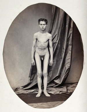 view A standing young man, naked and viewed in full length; he appears unable to straighten his body. Photograph by L. Haase after H.W. Berend, c. 1865.