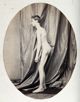 A standing young man, naked and viewed from the side in full length; he appears unable to straighten his body. Photograph by L. Haase after H.W. Berend, c. 1865.