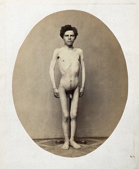 A standing young man, naked and viewed from the front in full length; he appears emaciated. Photograph by L. Haase after H.W. Berend, c. 1865.