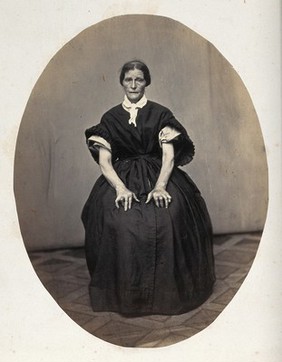 A seated woman, viewed from the front in full length; her hands are deformed. Photograph by L. Haase after H.W. Berend, c. 1865.