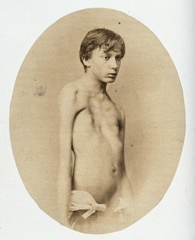 A young man, standing, unclothed to the waist; his chest is deformed. Photograph by L. Haase after H.W. Berend, c. 1865.