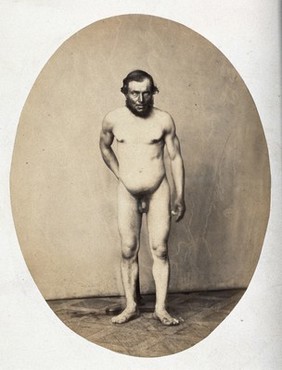 A naked man, standing, viewed in full length from the front; he is holding on to a stand, just discernible behind his back. Photograph by L. Haase after H.W. Berend, c. 1865.