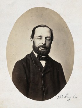 A seated man, head and shoulders; the right side of his face is different from the left. Photograph by L. Haase after H.W. Berend, 1864.