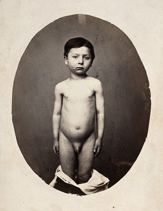 A standing child, naked, viewed from the front; his shoulders are uneven. Photograph by L. Haase after H.W. Berend, c. 1865.