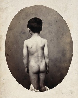 view A standing child, naked, viewed from behind; his shoulders are uneven. Photograph by L. Haase after H.W. Berend, c. 1865.