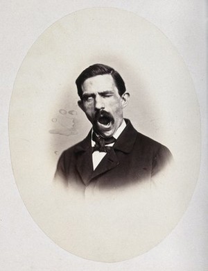 view A man, head and shoulders; his face is contorted. Photograph by L. Haase after H.W. Berend, c. 1865.