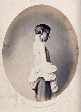 A young man, naked to the waist and viewed from the side; he has a swelling on the back of his neck. Photograph by L. Haase after H.W. Berend, c. 1865.