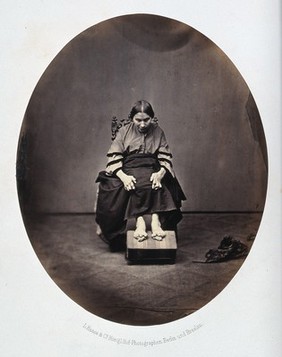 A sitting woman, her fingers and toes are severely deformed. Photograph by L. Haase after H.W. Berend, c. 1865.