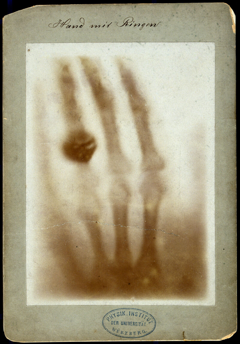 The bones of a hand with a ring on one finger, viewed through xray