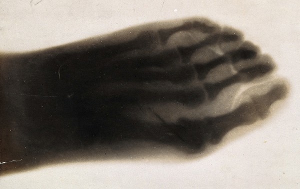 The bones of a pantomime artist's foot, viewed through x-ray; revealing a needle by one of the toes. Photoprint from radiograph after Sir Arthur Schuster, 1896.