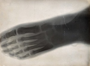 view The bones of a foot, viewed through x-ray. Photoprint from radiograph after Sir Arthur Schuster, 1896.