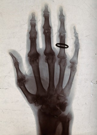 The bones of a hand, with a ring on one finger, viewed through x-ray. Photoprint from radiograph after Sir Arthur Schuster, 1896.