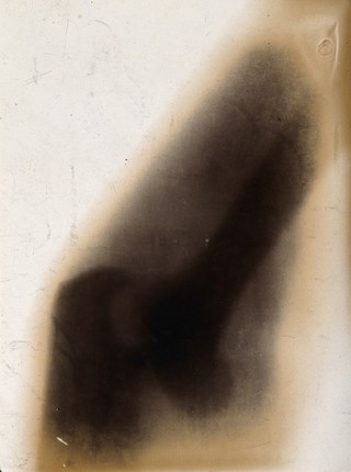 The bones in the joint of an elbow, viewed through x-ray. Photoprint from radiograph after Sir Arthur Schuster, 1896.