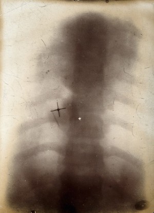 view The bones of the ribs and vertebral column, viewed through x-ray. Photoprint from radiograph after Sir Arthur Schuster, 1896.