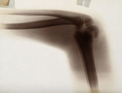 The fracture and dislocation of bones in an elbow joint, viewed through x-ray. Photoprint from radiograph after Sir Arthur Schuster, 1896.