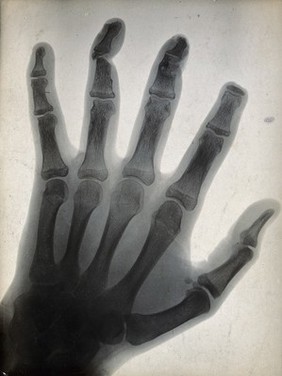 The bones of a hand, with the tip of the index finger missing, viewed through x-ray. Photoprint from radiograph after Sir Arthur Schuster, 1896.