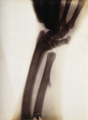 The bones of a forearm, viewed through x-ray. Photoprint from radiograph after Sir Arthur Schuster, 1896.