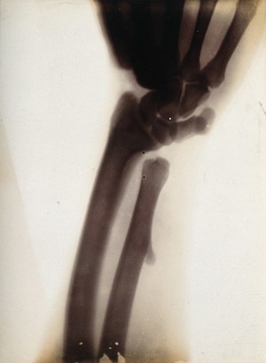 view The bones of a forearm, viewed through x-ray. Photoprint from radiograph after Sir Arthur Schuster, 1896.