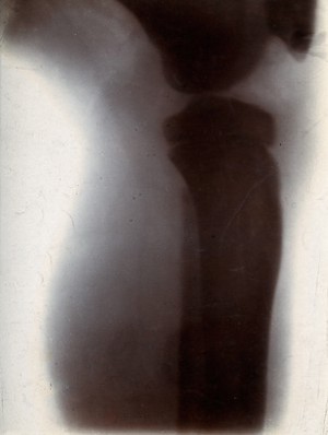 view The bones of a knee joint of a boy, viewed through x-ray. Photoprint from radiograph after Sir Arthur Schuster, 1896.