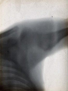 The bones of a shoulder joint and ribs, viewed through x-ray. Photoprint from radiograph after Sir Arthur Schuster, 1896.