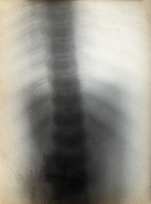 view The bones of the ribs and vertebral column, viewed through x-ray. Photoprint from radiograph after Sir Arthur Schuster, 1896.