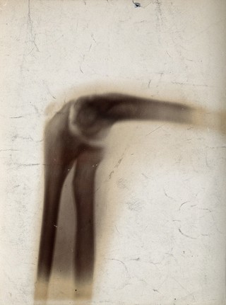 The bones of an elbow joint, viewed through x-ray. Photoprint from radiograph after Sir Arthur Schuster, 1896.