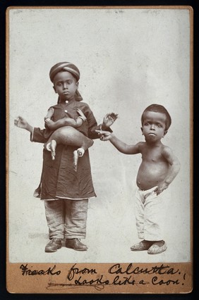 A young Indian boy with a parasitic headless attachment. Photograph, 18--.