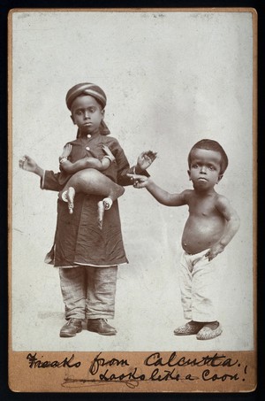 view A young Indian boy with a parasitic headless attachment. Photograph, 18--.