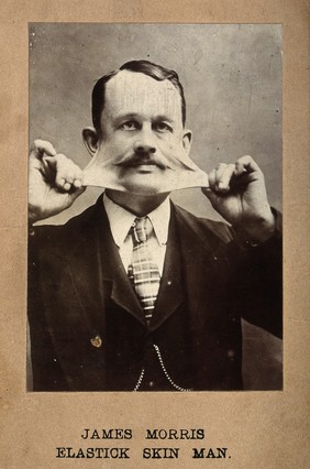James Morris, stretching the skin on his face. Photograph.