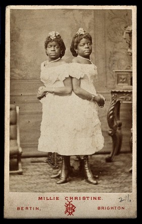 The Millie-Christine sisters, conjoined twins, standing. Photograph by Bertin, c. 1874.